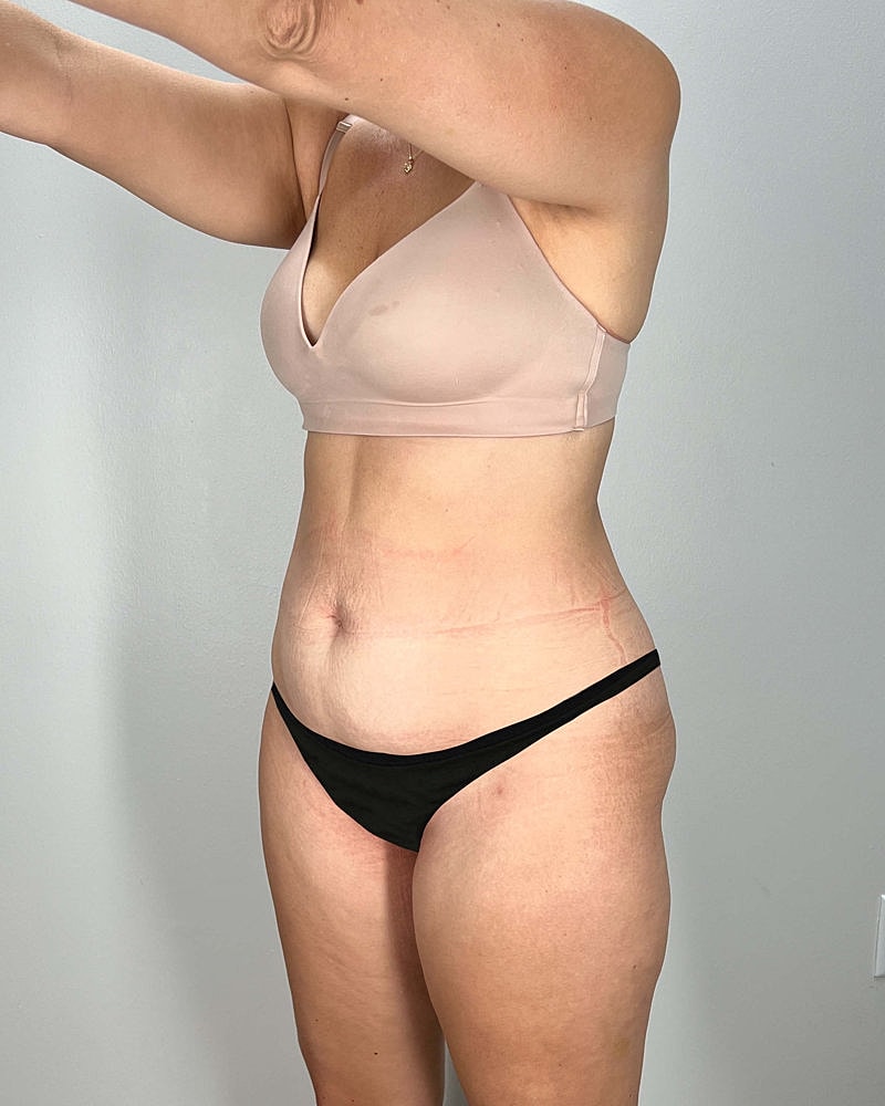Tummy Tuck Before & After