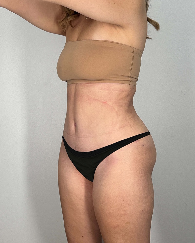 Tummy Tuck Before & After