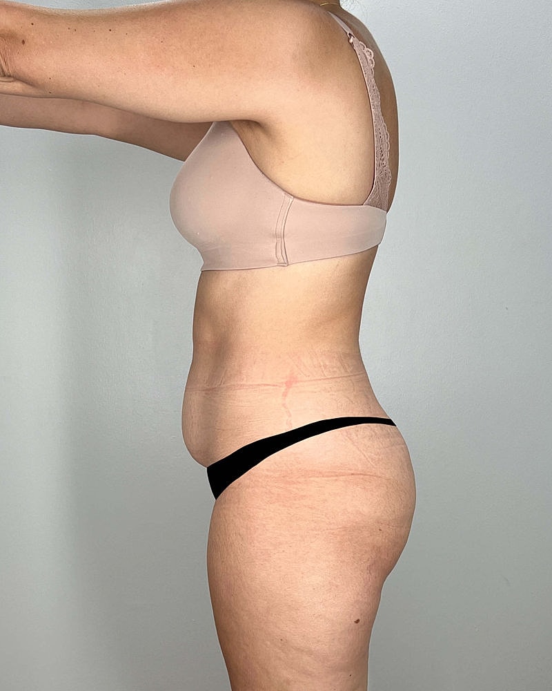 Tummy Tuck Before & After
