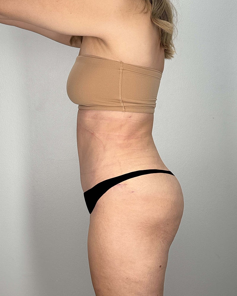 Tummy Tuck Before & After