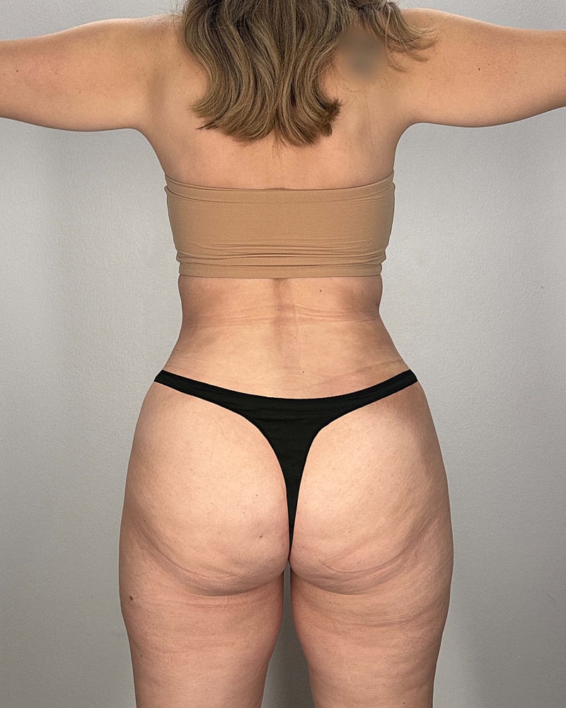 Tummy Tuck Before & After