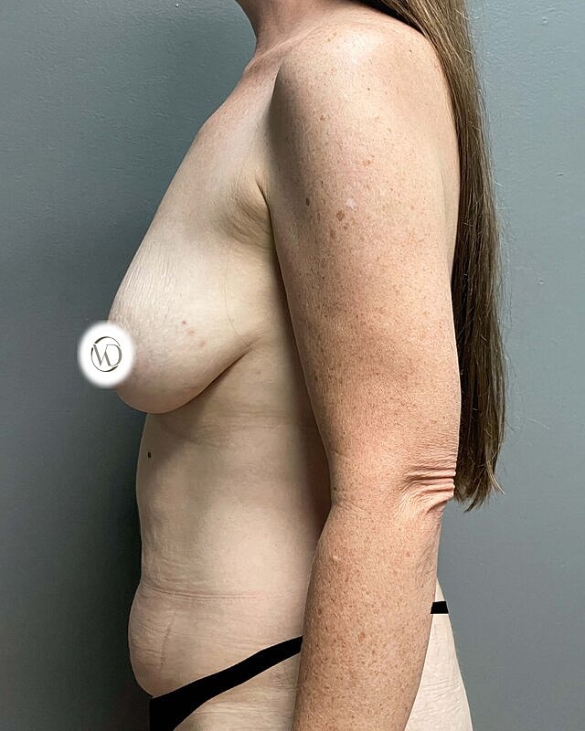 Tummy Tuck Before & After