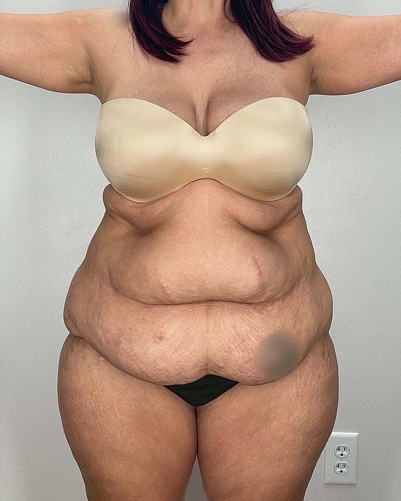 Tummy Tuck Before & After