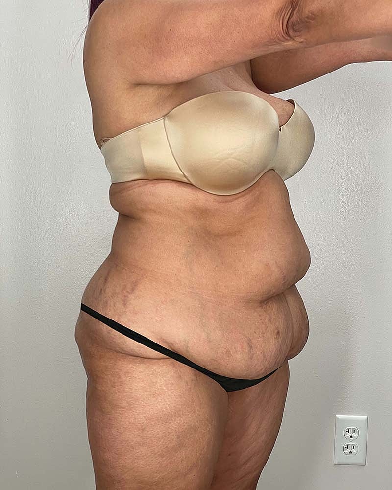 Tummy Tuck Before & After