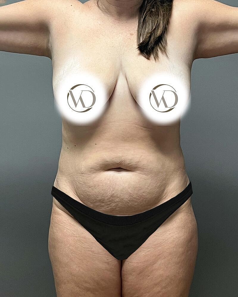 Tummy Tuck Before & After
