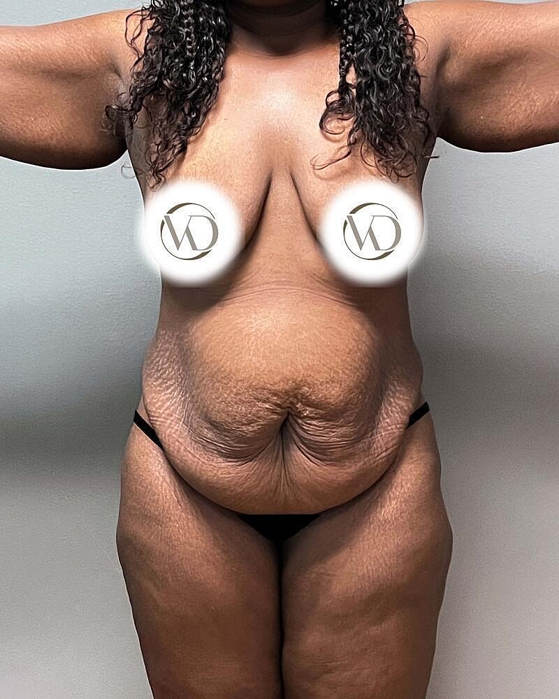 Tummy Tuck Before & After