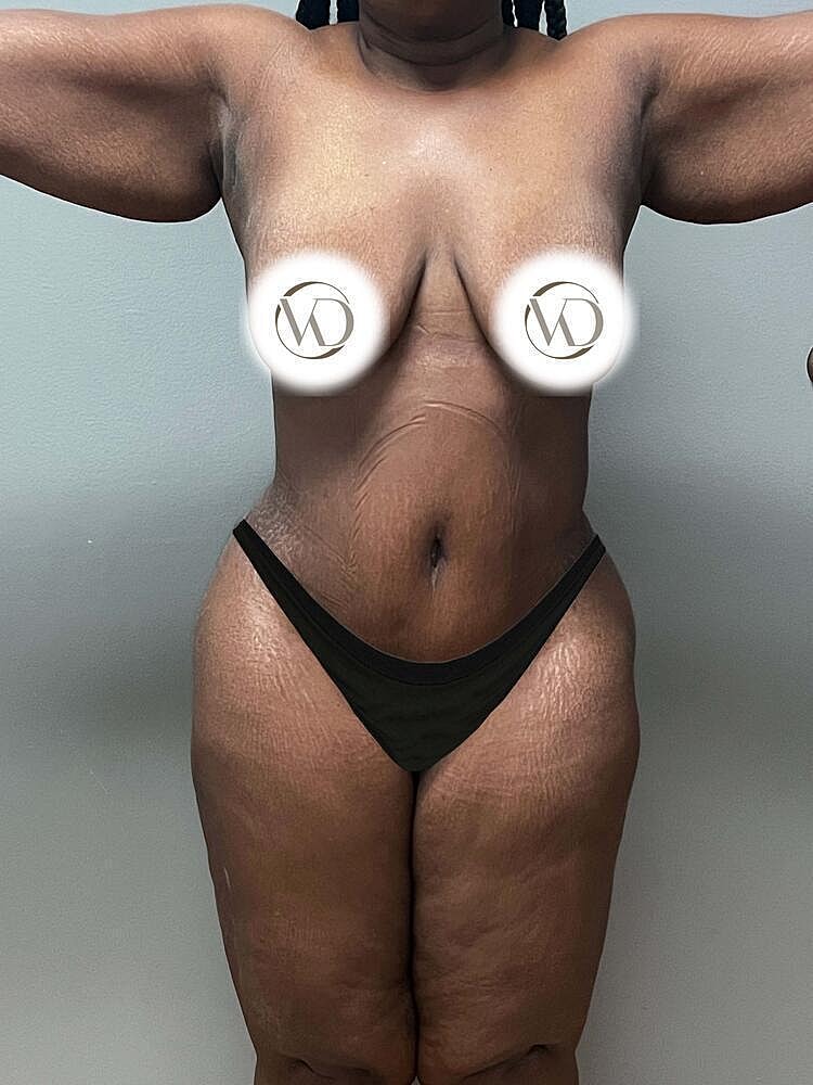 Tummy Tuck Before & After
