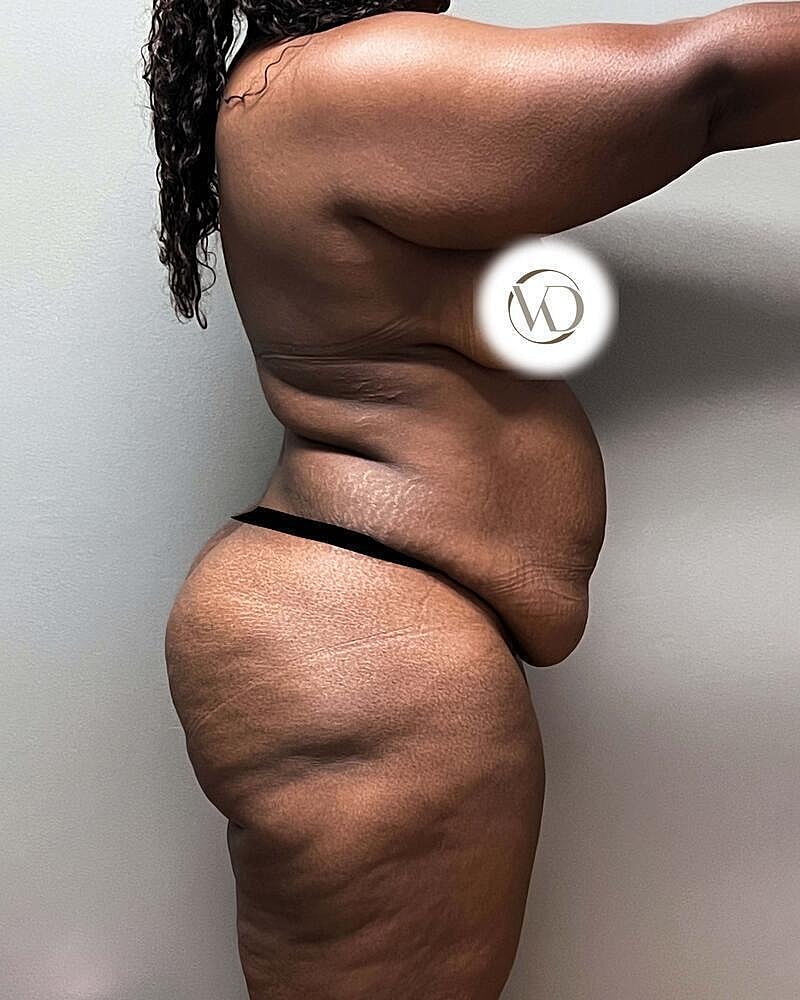 Tummy Tuck Before & After