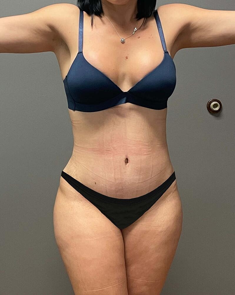 Tummy Tuck Before & After