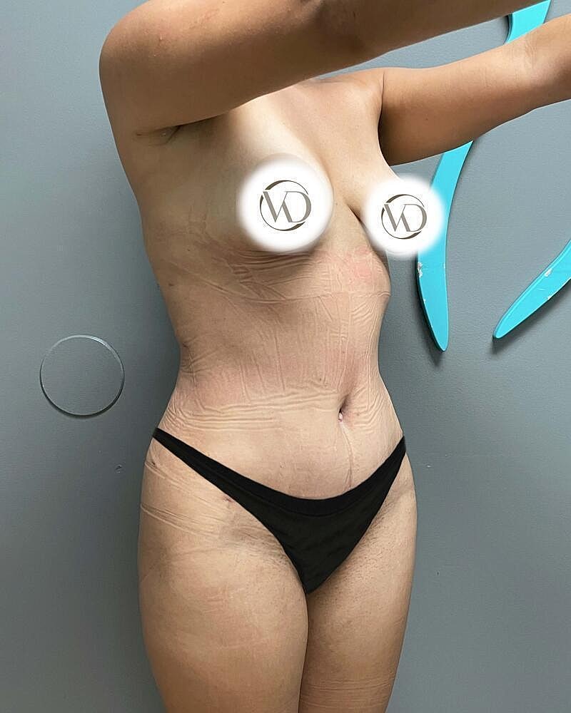 Tummy Tuck Before & After