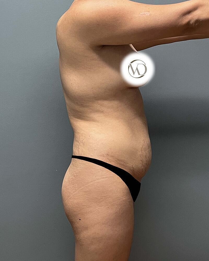 Tummy Tuck Before & After