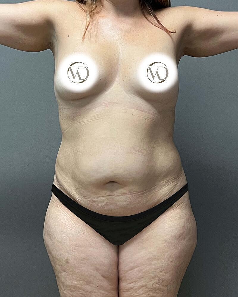 Tummy Tuck Before & After