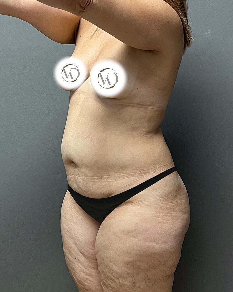 Tummy Tuck Before & After