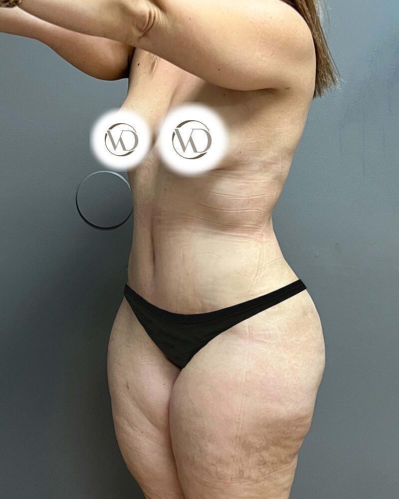 Tummy Tuck Before & After