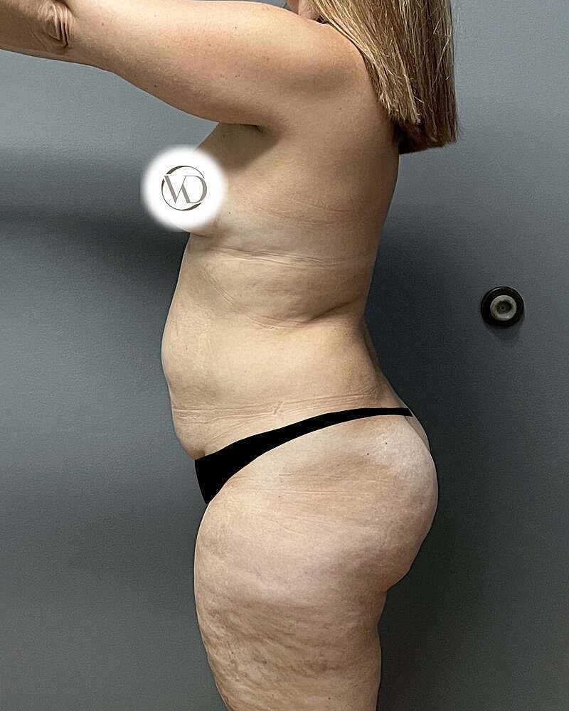 Tummy Tuck Before & After