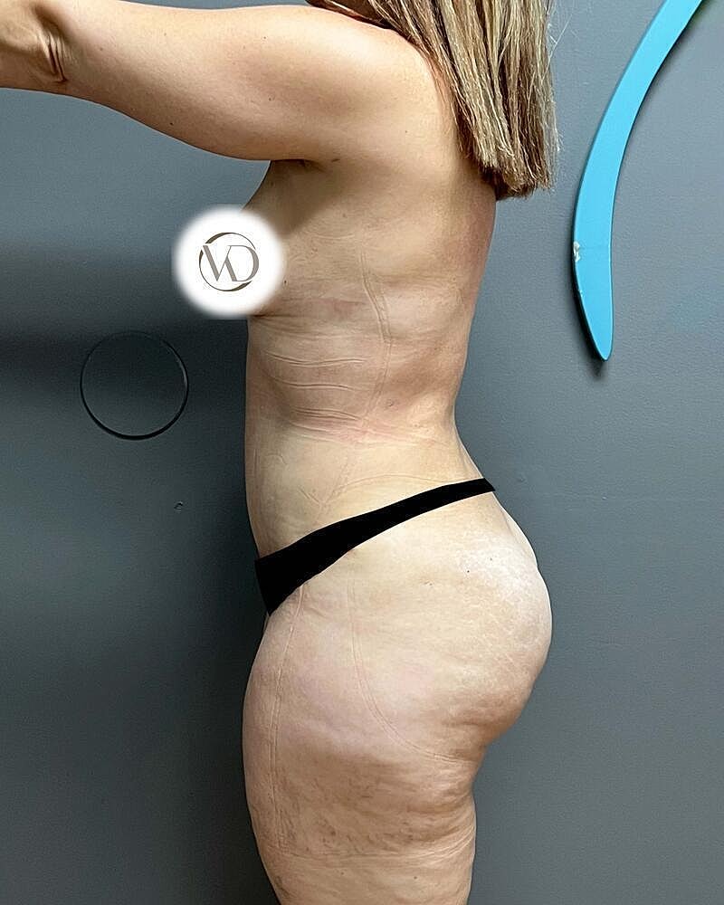 Tummy Tuck Before & After