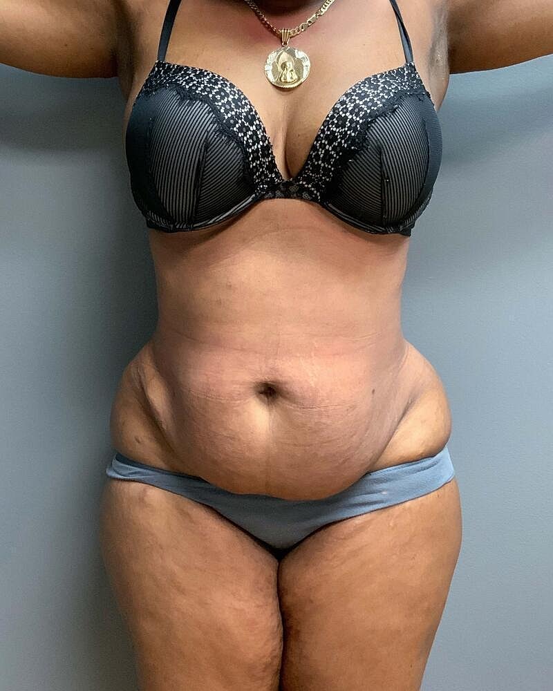Tummy Tuck Before & After