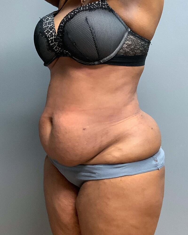 Tummy Tuck Before & After