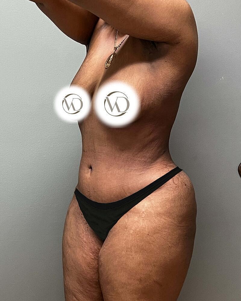 Tummy Tuck Before & After