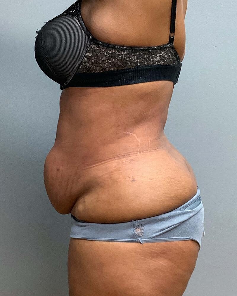 Tummy Tuck Before & After