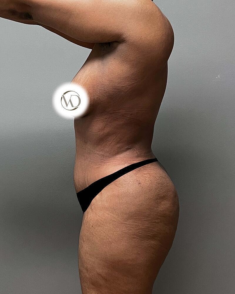 Tummy Tuck Before & After