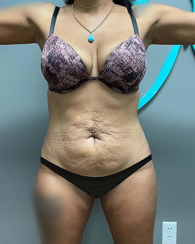 Tummy Tuck Before & After