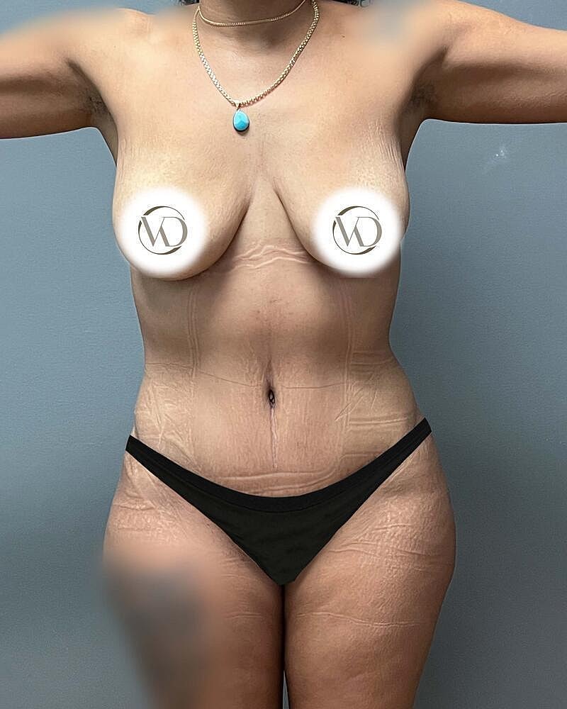 Tummy Tuck Before & After