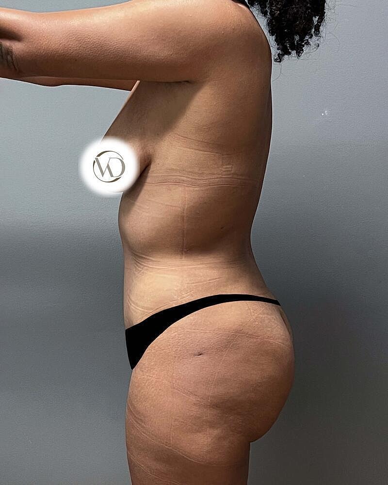 Tummy Tuck Before & After