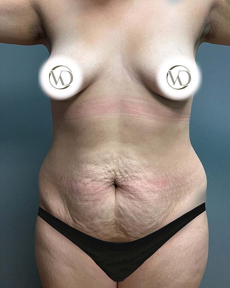 Tummy Tuck Before & After