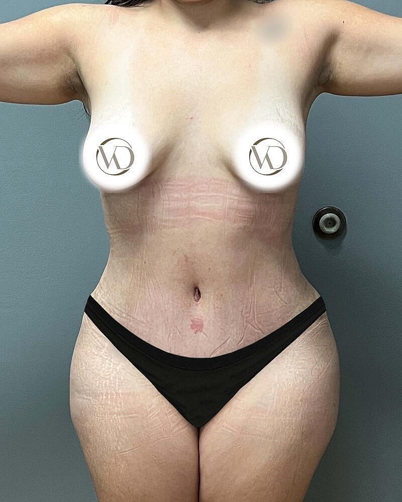 Tummy Tuck Before & After
