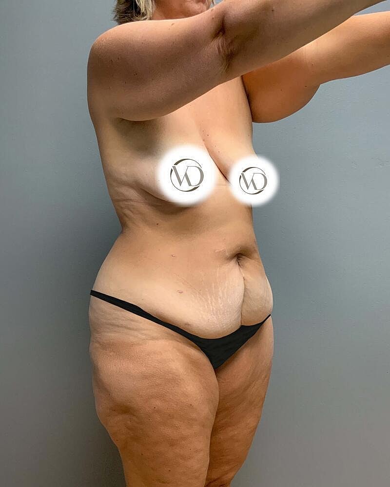 Tummy Tuck Before & After