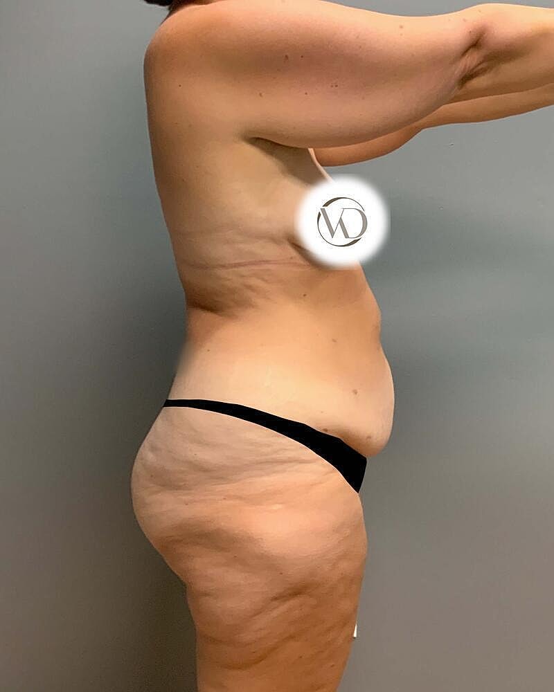 Tummy Tuck Before & After