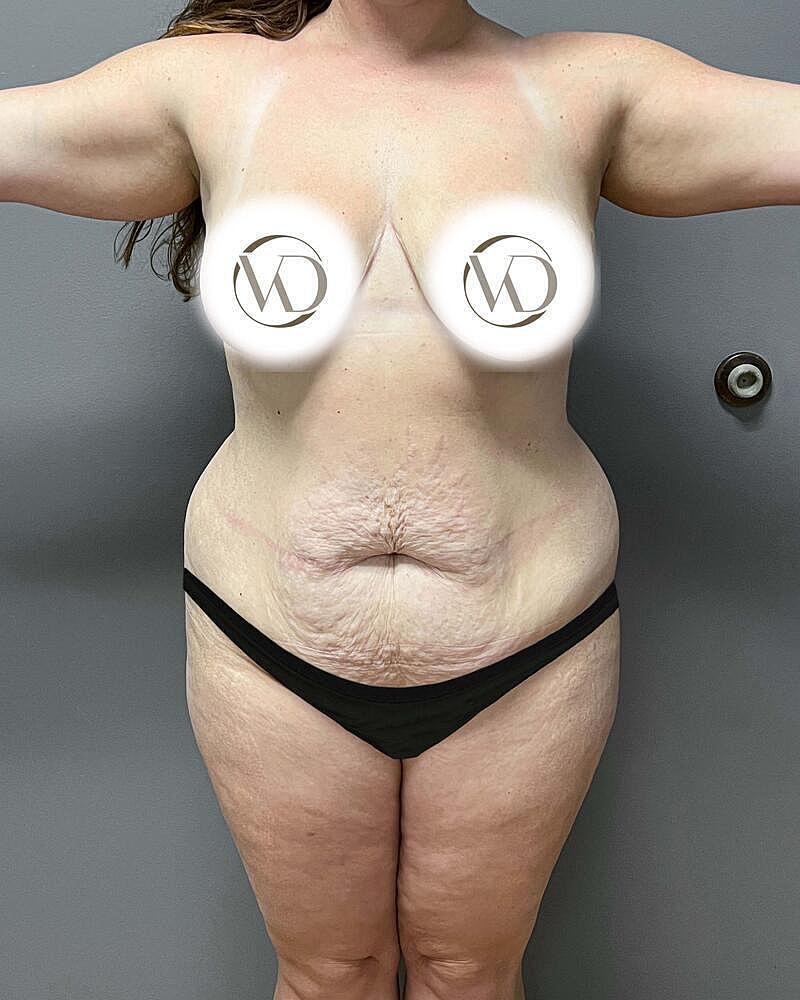 Tummy Tuck Before & After