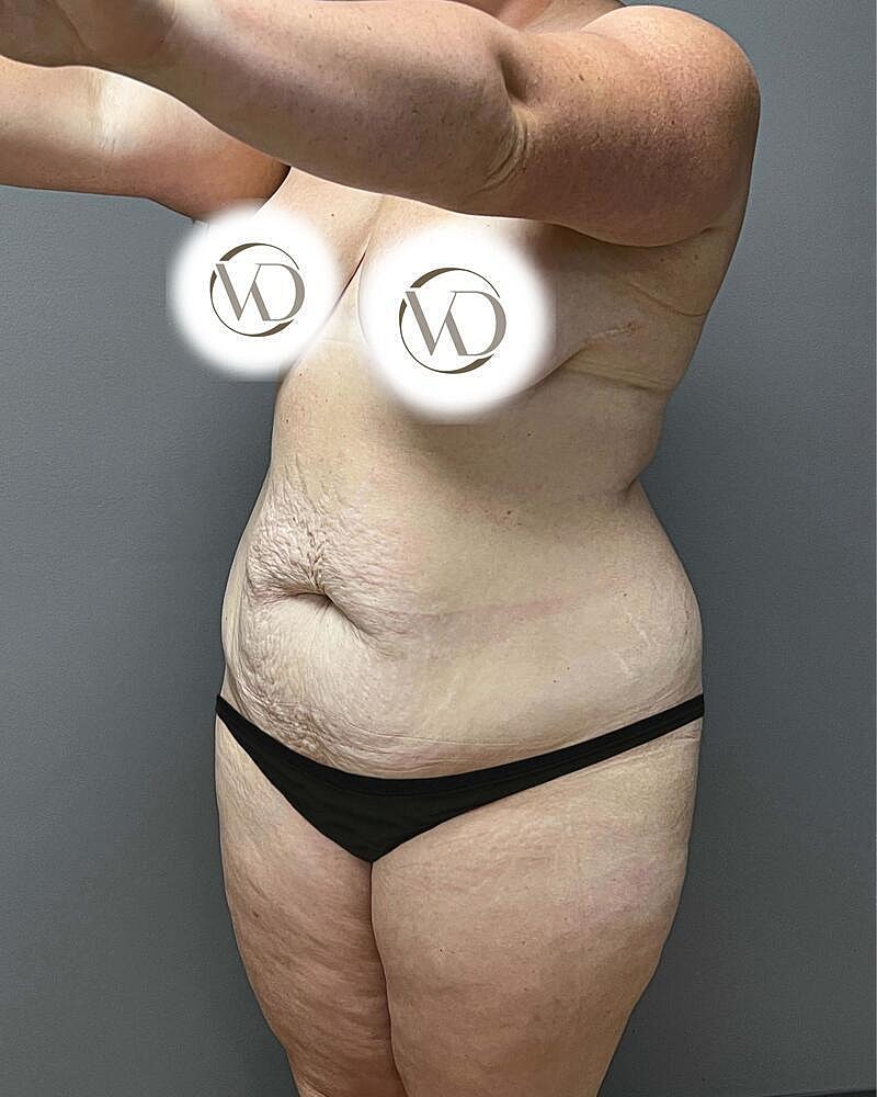 Tummy Tuck Before & After