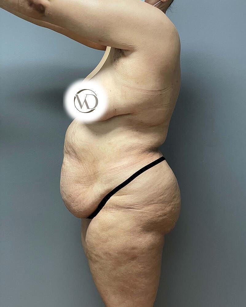 Tummy Tuck Before & After