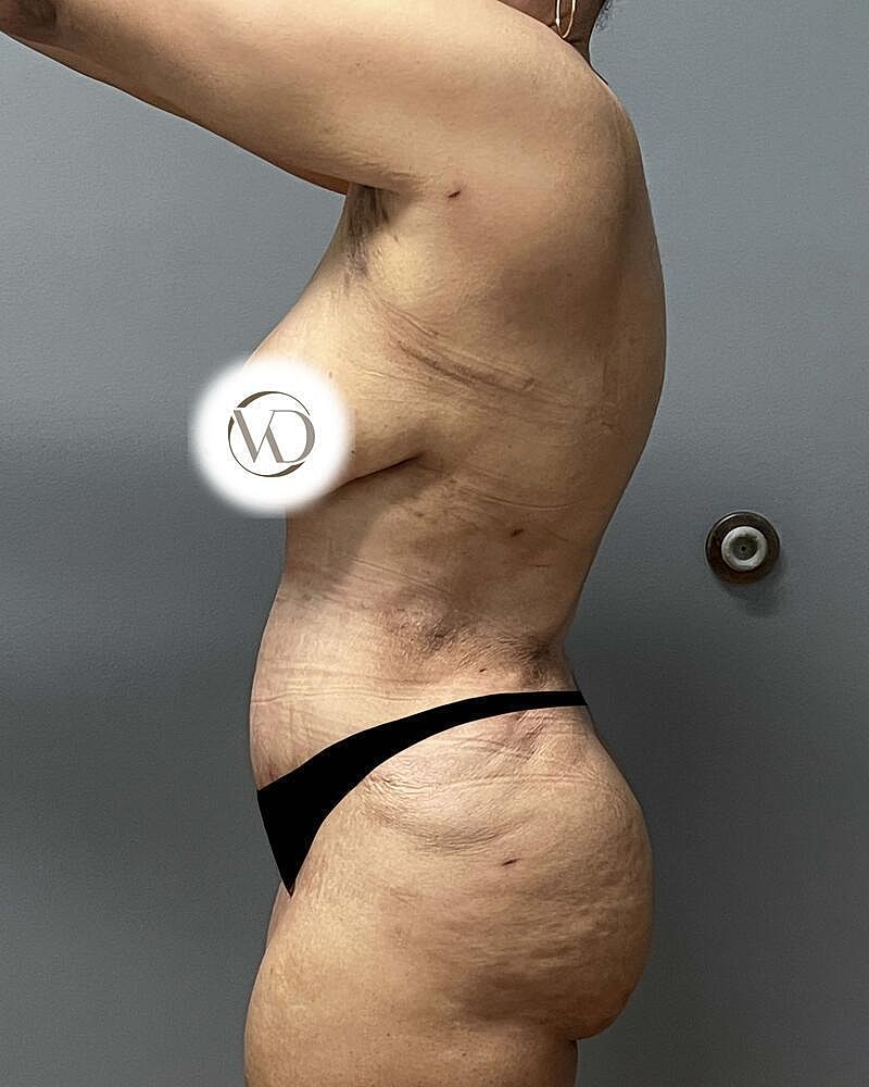 Tummy Tuck Before & After