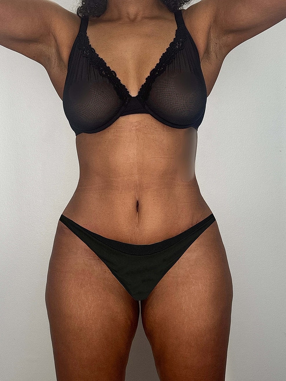 Tummy Tuck Gallery Before & After