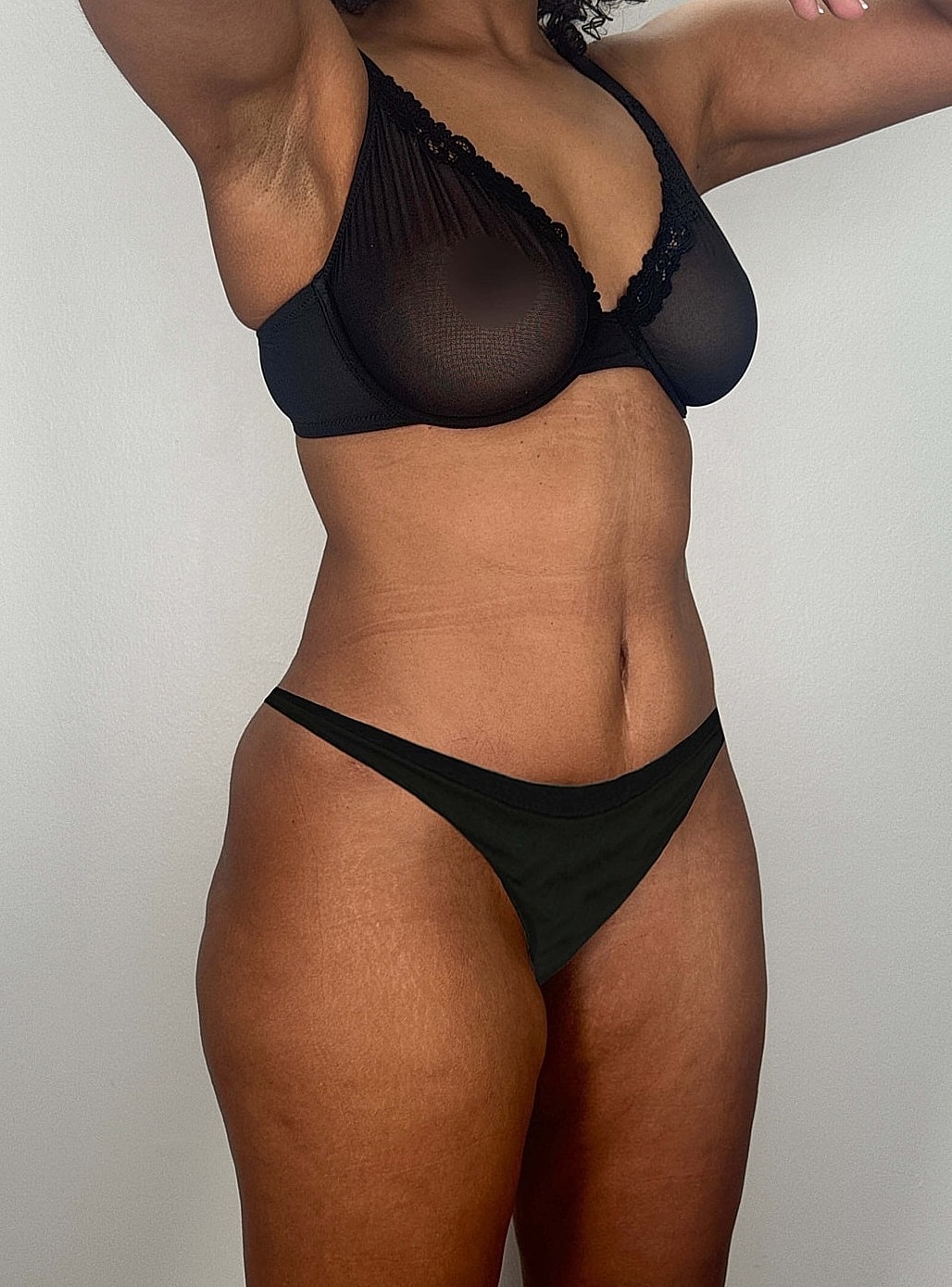 Tummy Tuck Gallery Before & After