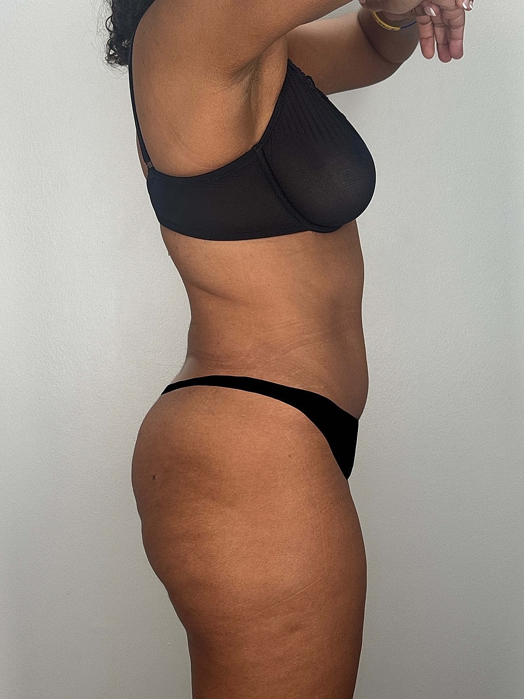 Tummy Tuck Gallery Before & After