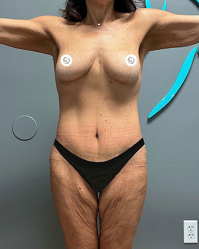 Tummy Tuck Before & After