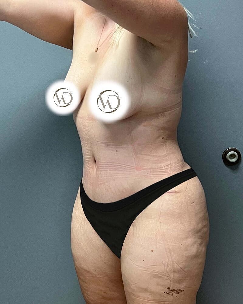 Tummy Tuck Before & After