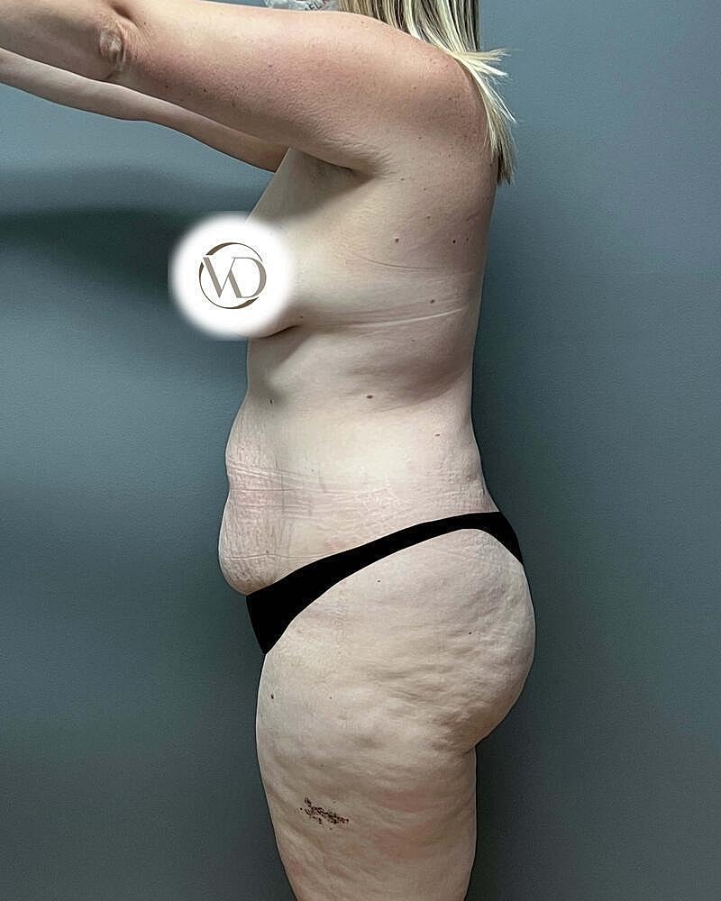 Tummy Tuck Before & After
