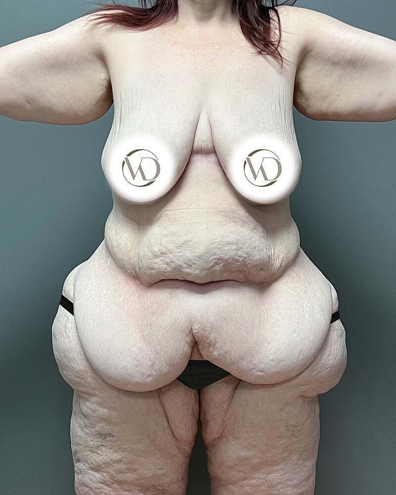 Tummy Tuck Before & After