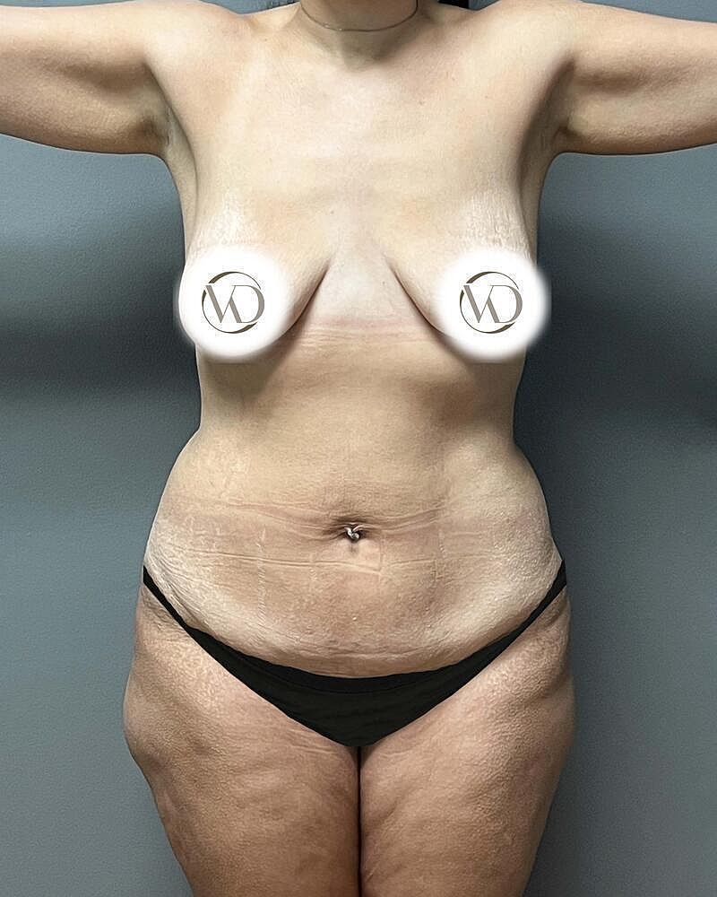 Tummy Tuck Before & After