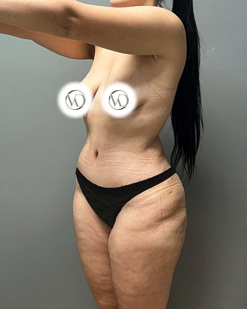 Tummy Tuck Before & After