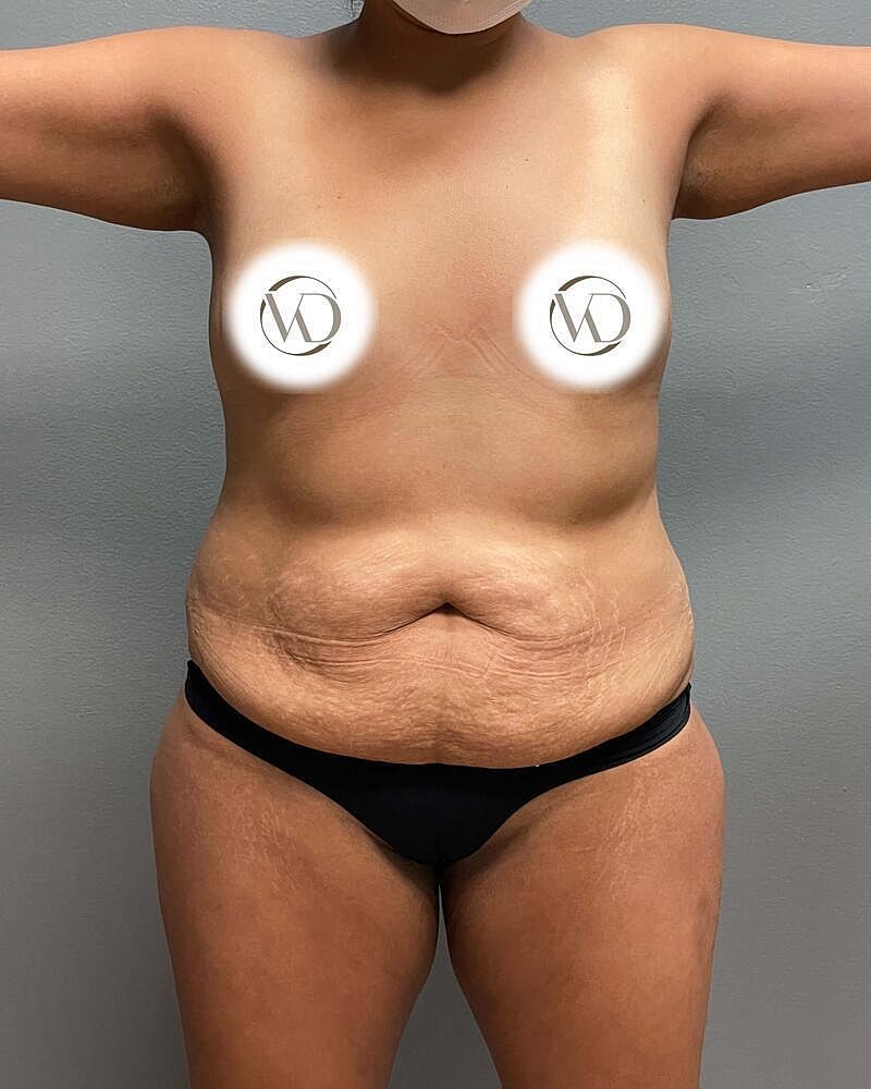 Tummy Tuck Before & After