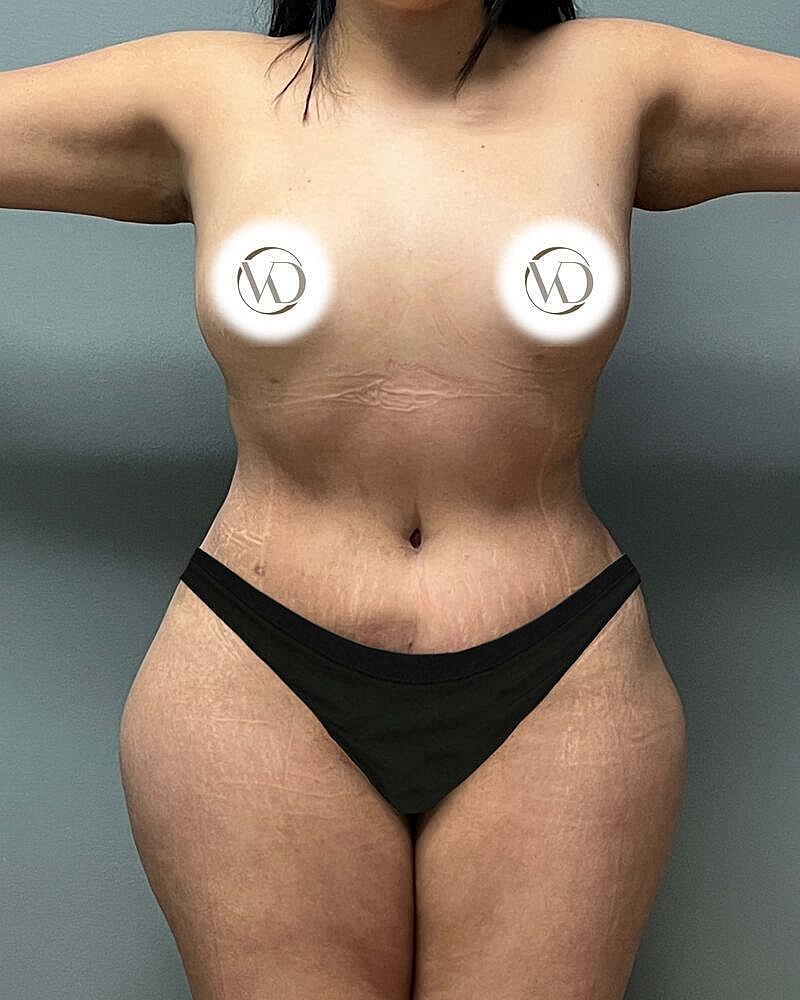 Tummy Tuck Before & After