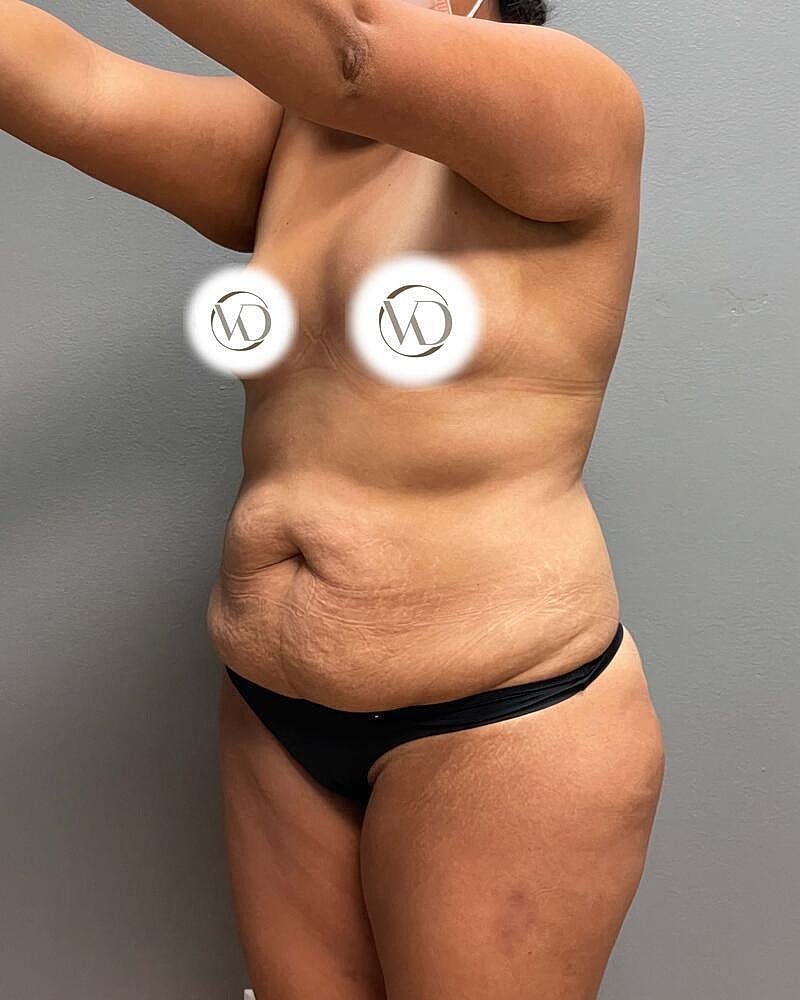 Tummy Tuck Before & After