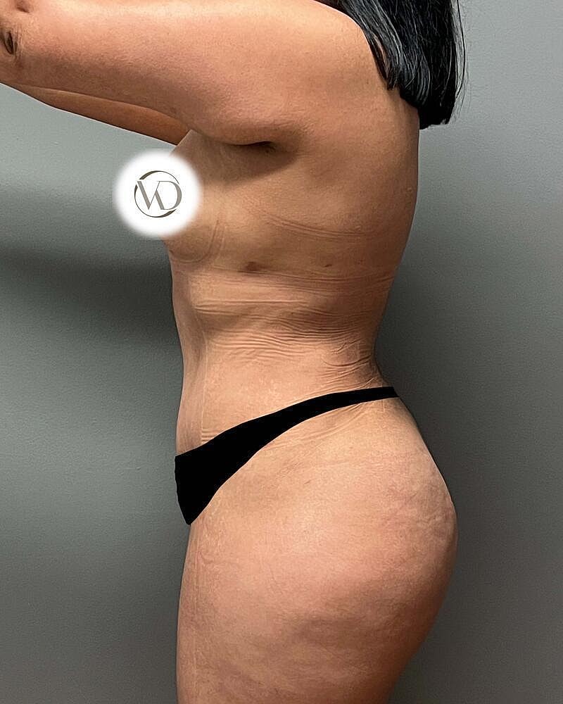 Tummy Tuck Before & After