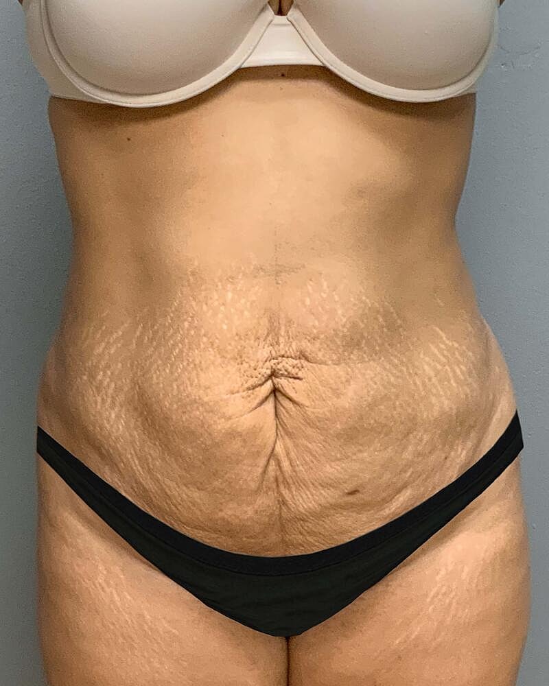 Tummy Tuck Before & After